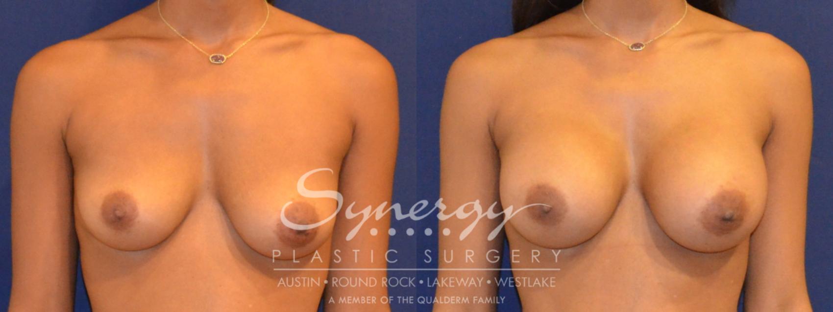 Before & After Breast Augmentation Case 358 View #1 View in Austin, TX