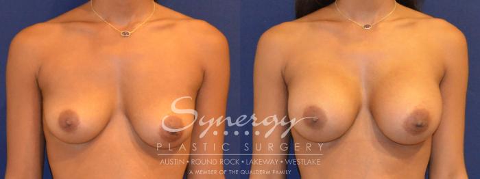 Before & After Breast Augmentation Case 358 View #1 View in Austin, TX