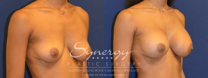 Before & After Breast Augmentation Case 358 View #3 View in Austin, TX