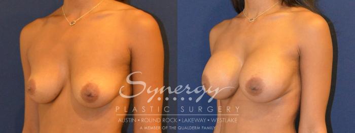 Before & After Breast Augmentation Case 358 View #5 View in Austin, TX