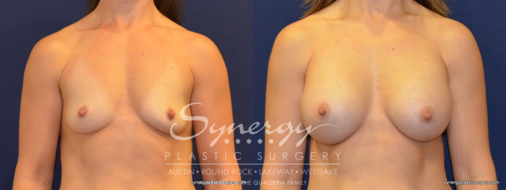 Before & After Breast Augmentation Case 359 View #1 View in Austin, TX
