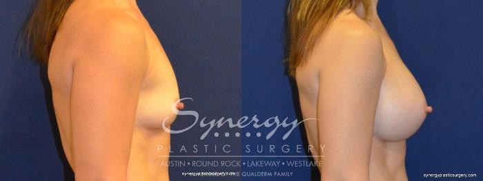 Before & After Breast Augmentation Case 359 View #2 View in Austin, TX