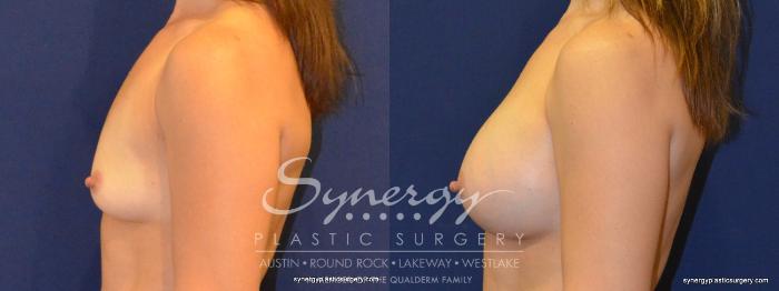 Before & After Breast Augmentation Case 359 View #4 View in Austin, TX