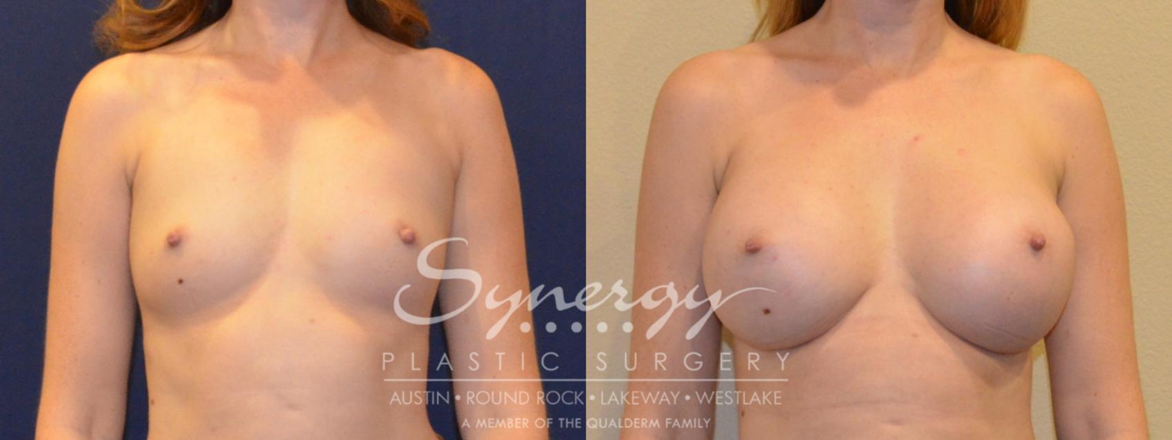 Before & After Breast Augmentation Case 361 View #1 View in Austin, TX