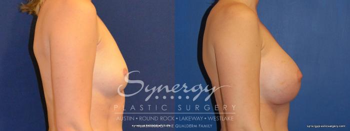 Before & After Breast Augmentation Case 373 View #2 View in Austin, TX