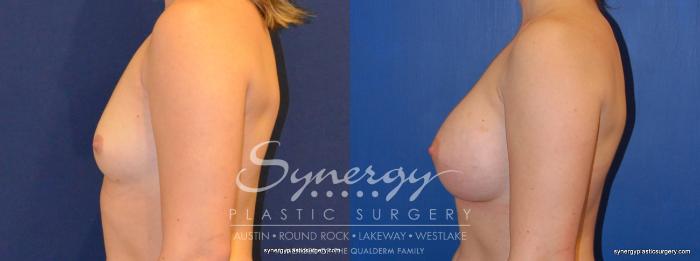Before & After Breast Augmentation Case 373 View #4 View in Austin, TX