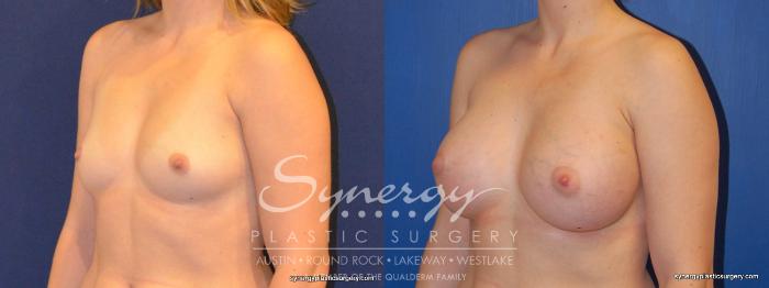 Before & After Breast Augmentation Case 373 View #5 View in Austin, TX