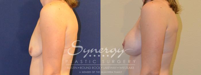 Before & After Breast Augmentation Case 379 View #4 View in Austin, TX