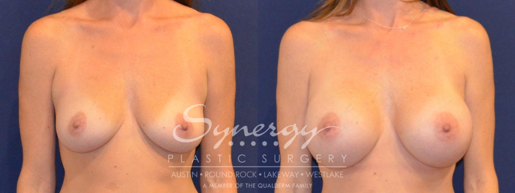 Before & After Breast Augmentation Case 386 View #1 View in Austin, TX