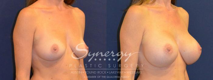 Before & After Breast Augmentation Case 386 View #3 View in Austin, TX