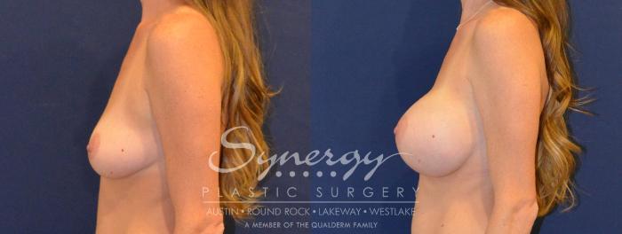 Before & After Breast Augmentation Case 386 View #4 View in Austin, TX