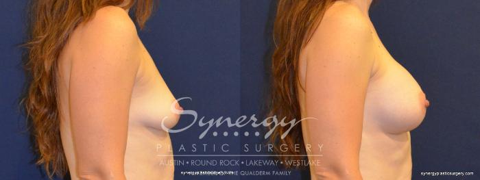 Before & After Breast Augmentation Case 390 View #2 View in Austin, TX