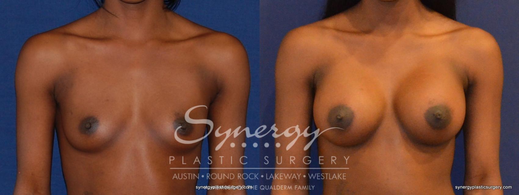 Before & After Breast Augmentation Case 397 View #1 View in Austin, TX