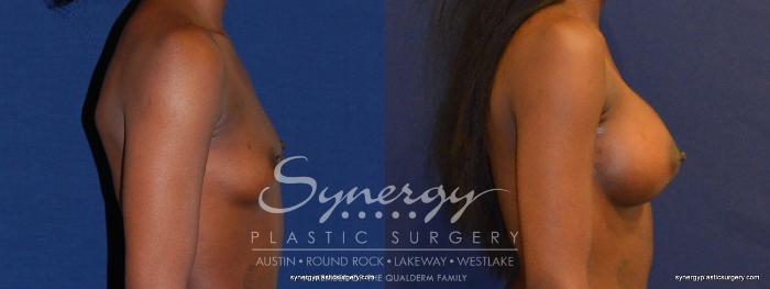 Before & After Breast Augmentation Case 397 View #2 View in Austin, TX