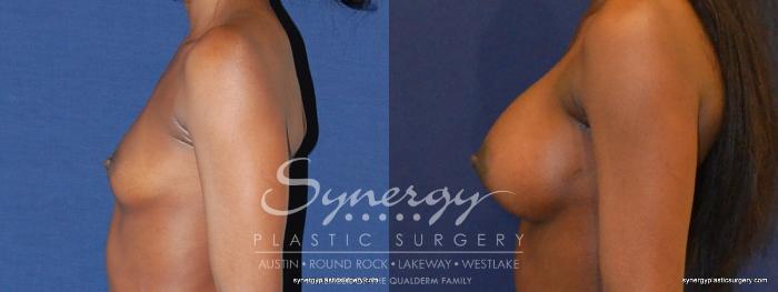 Before & After Breast Augmentation Case 397 View #4 View in Austin, TX