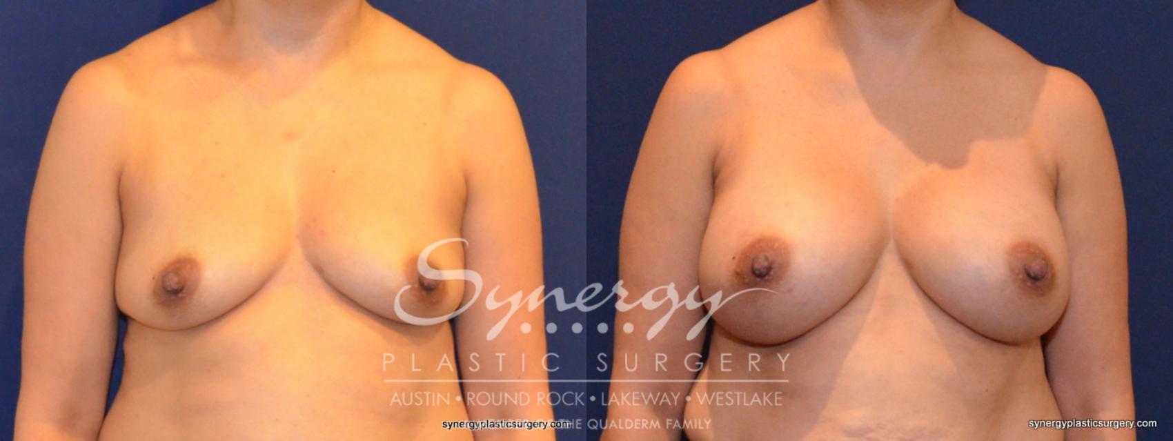 Before & After Breast Augmentation Case 402 View #1 View in Austin, TX