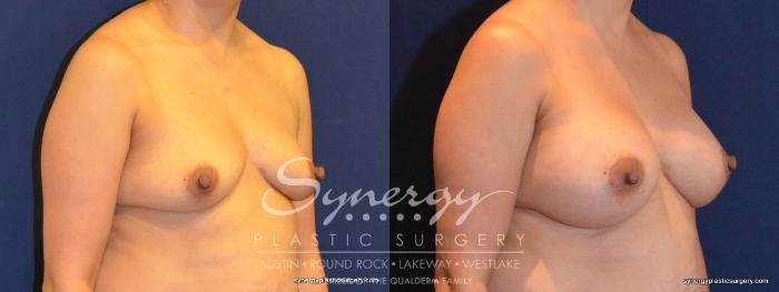 Before & After Breast Augmentation Case 402 View #3 View in Austin, TX