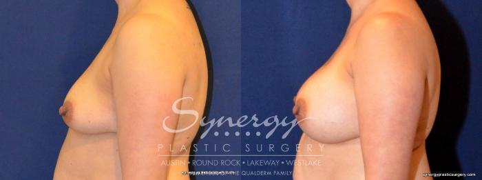Before & After Breast Augmentation Case 402 View #4 View in Austin, TX