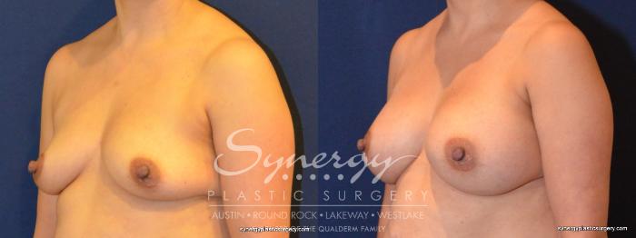 Before & After Breast Augmentation Case 402 View #5 View in Austin, TX