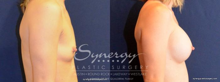Before & After Breast Augmentation Case 403 View #2 View in Austin, TX
