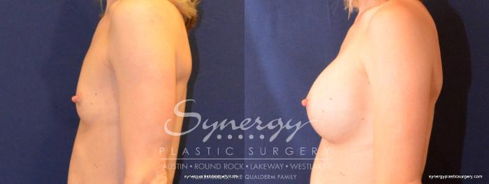 Before & After Breast Augmentation Case 403 View #4 View in Austin, TX