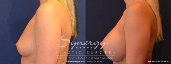 Before & After Breast Augmentation Case 405 View #5 View in Austin, TX