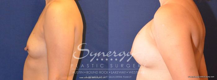 Before & After Breast Augmentation Case 408 View #5 View in Austin, TX