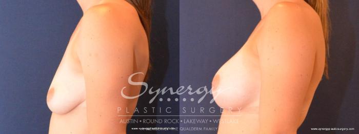 Before & After  Case 410 View #2 View in Austin, TX