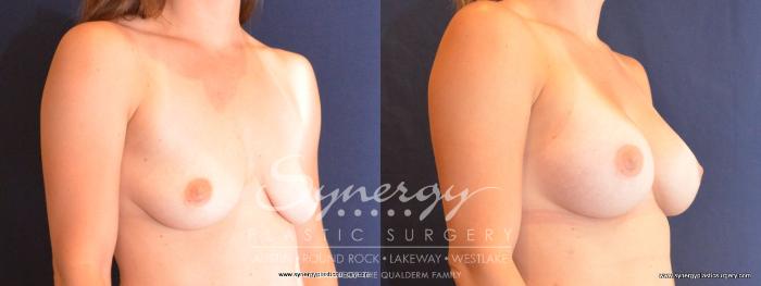 Before & After  Case 410 View #5 View in Austin, TX