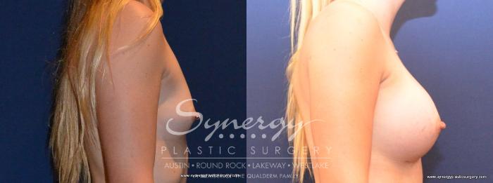 Before & After Breast Augmentation Case 411 View #2 View in Austin, TX
