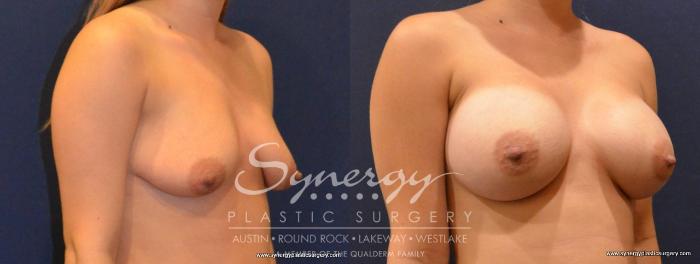 Before & After Breast Augmentation Case 413 View #2 View in Austin, TX