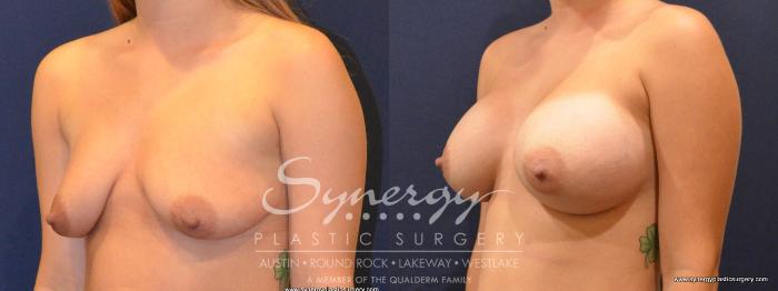 Before & After Breast Augmentation Case 413 View #3 View in Austin, TX