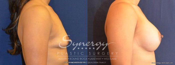 Before & After Breast Augmentation Case 416 View #2 View in Austin, TX