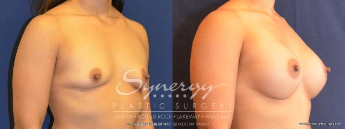 Before & After Breast Augmentation Case 416 View #3 View in Austin, TX