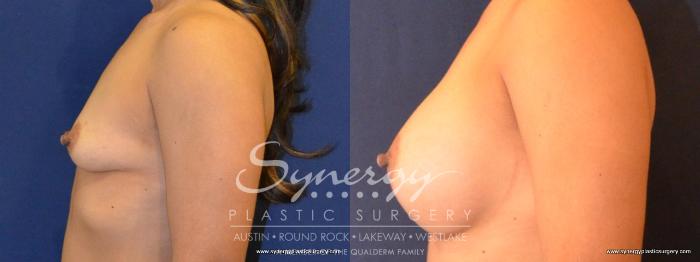 Before & After Breast Augmentation Case 416 View #4 View in Austin, TX