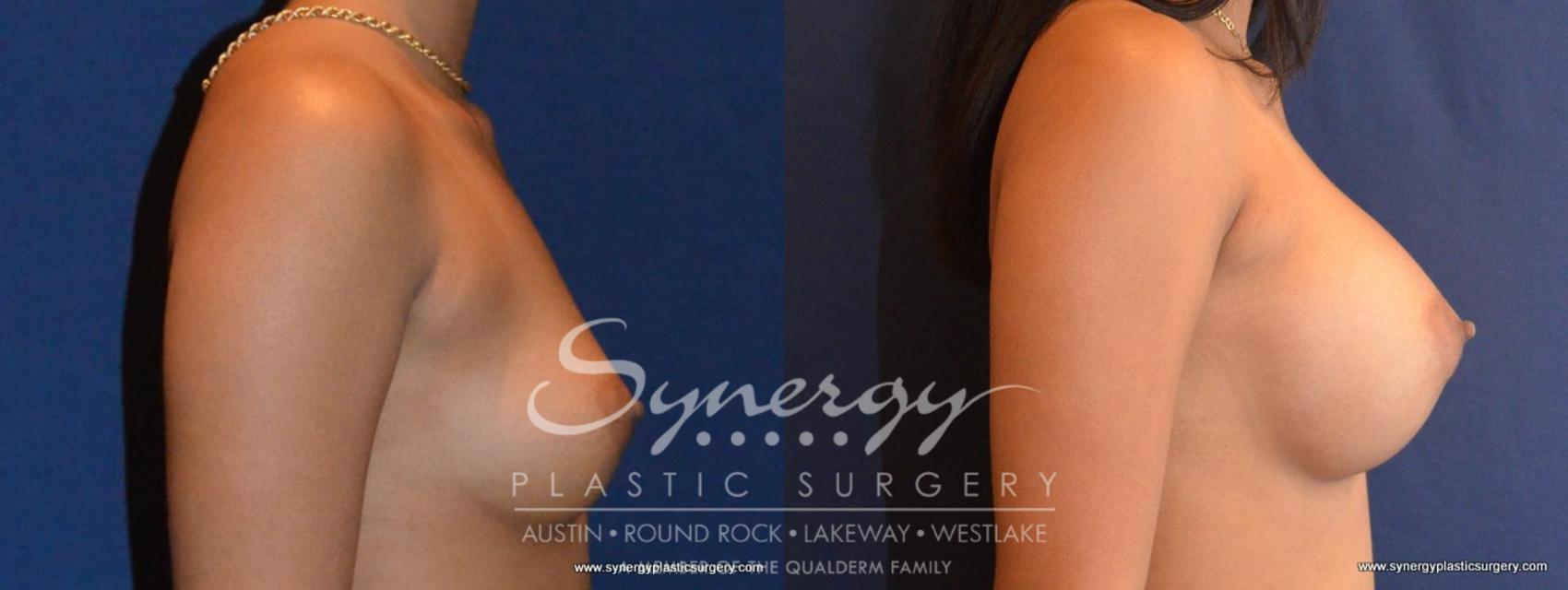 Before & After Breast Augmentation Case 417 View #1 View in Austin, TX