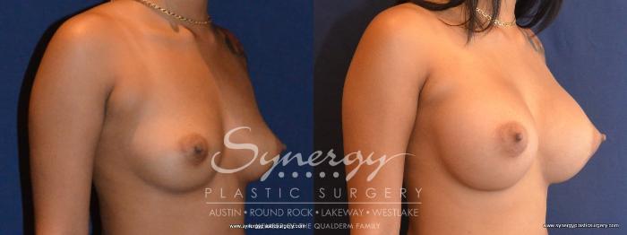 Before & After Breast Augmentation Case 417 View #2 View in Austin, TX