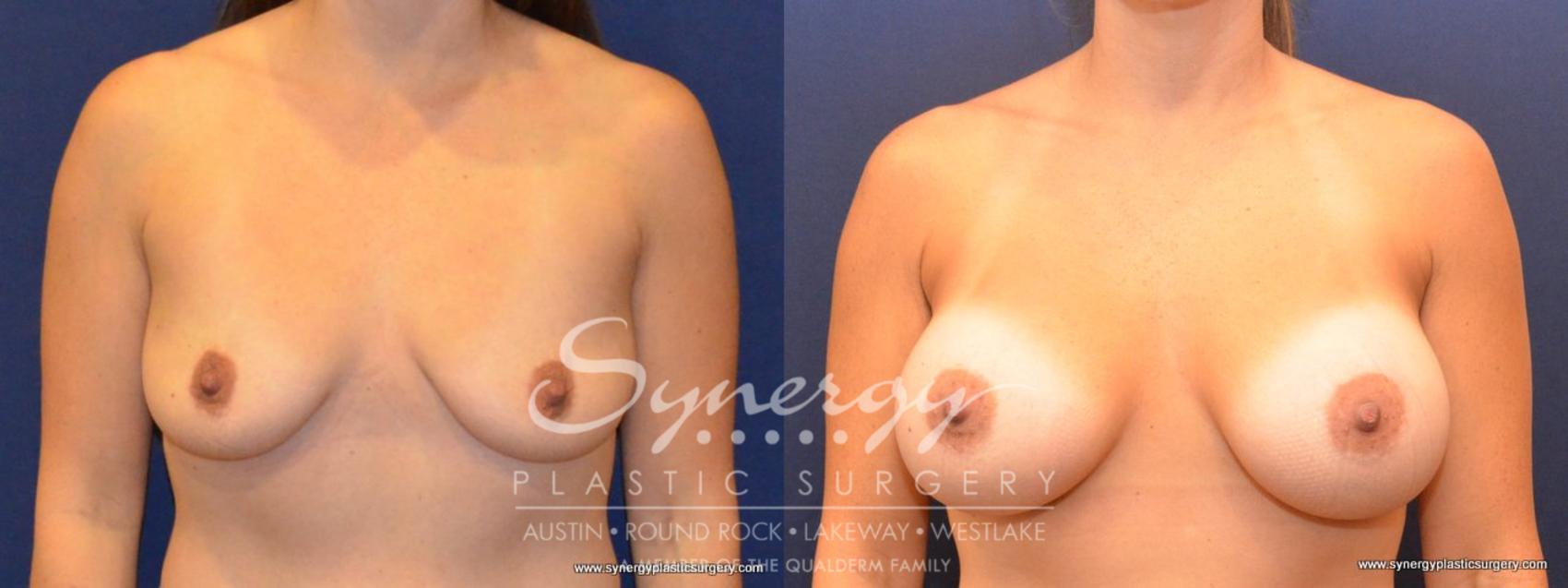 Before & After Breast Augmentation Case 422 View #1 View in Austin, TX