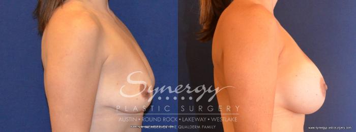 Before & After Breast Augmentation Case 422 View #2 View in Austin, TX