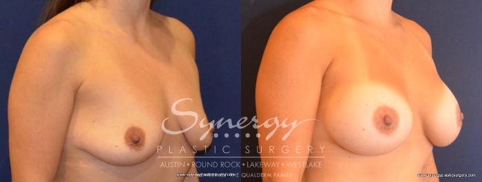 Before & After Breast Augmentation Case 422 View #3 View in Austin, TX
