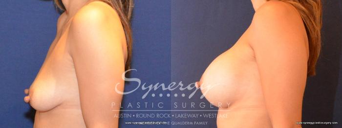 Before & After Breast Augmentation Case 423 View #2 View in Austin, TX