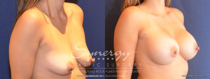 Before & After Breast Augmentation Case 423 View #5 View in Austin, TX