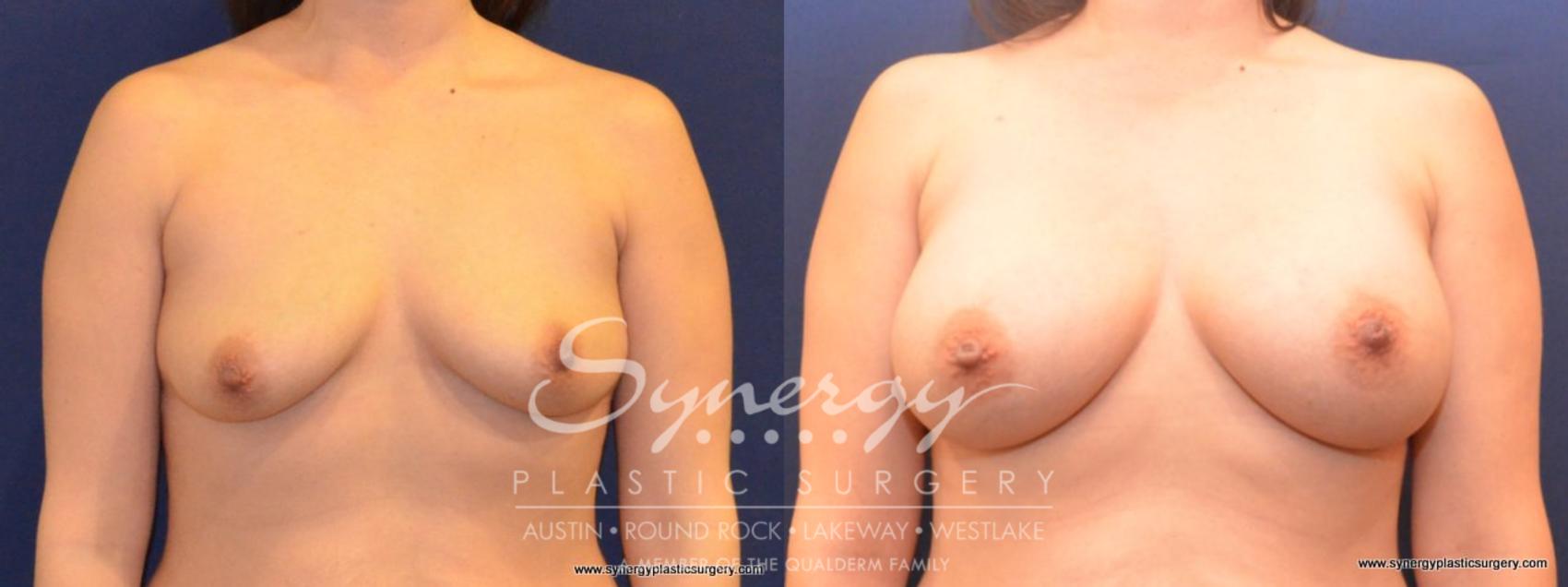 Before & After  Case 424 View #1 View in Austin, TX