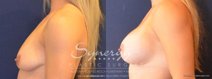 Before & After Breast Augmentation Case 425 View #3 View in Austin, TX