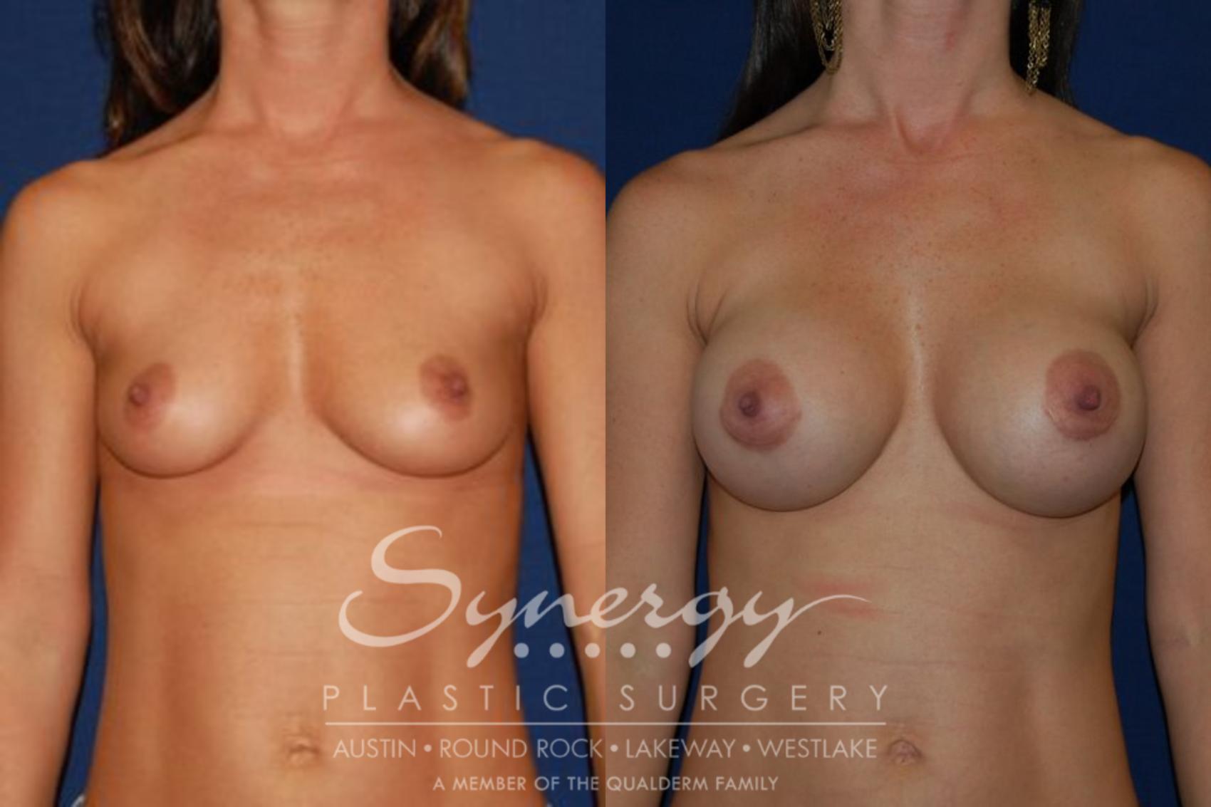 Before & After Breast Augmentation Case 43 View #1 View in Austin, TX