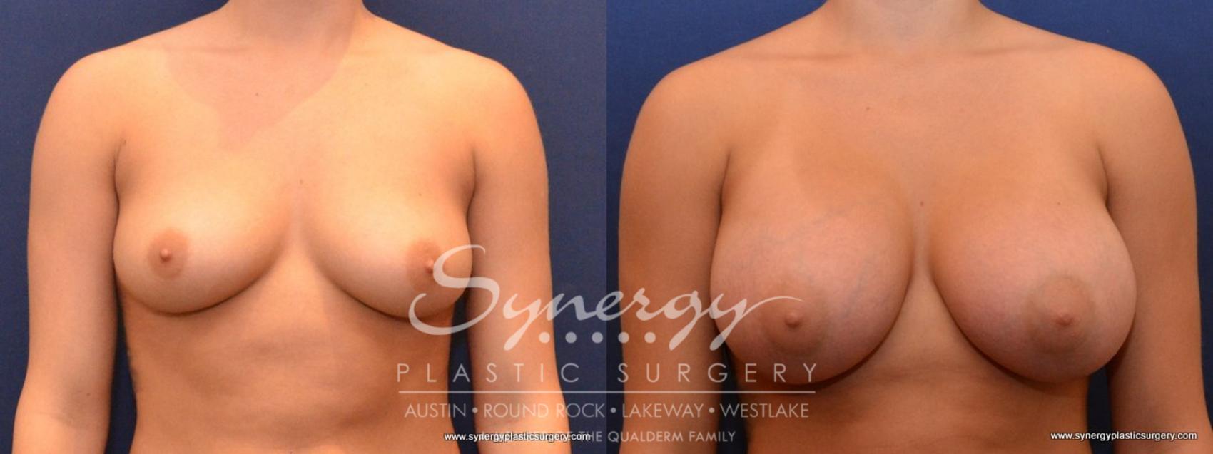 Before & After Breast Augmentation Case 436 View #1 View in Austin, TX