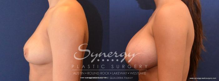 Before & After Breast Augmentation Case 436 View #2 View in Austin, TX