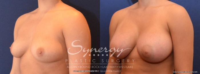 Before & After Breast Augmentation Case 436 View #3 View in Austin, TX