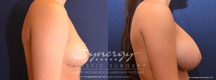Before & After Breast Augmentation Case 436 View #4 View in Austin, TX