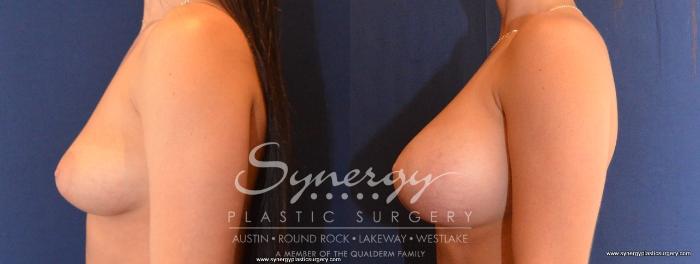 Before & After Breast Augmentation Case 437 View #2 View in Austin, TX